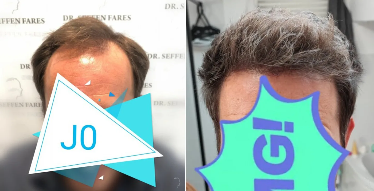 Patient 49, before and after hair transplant, view 1