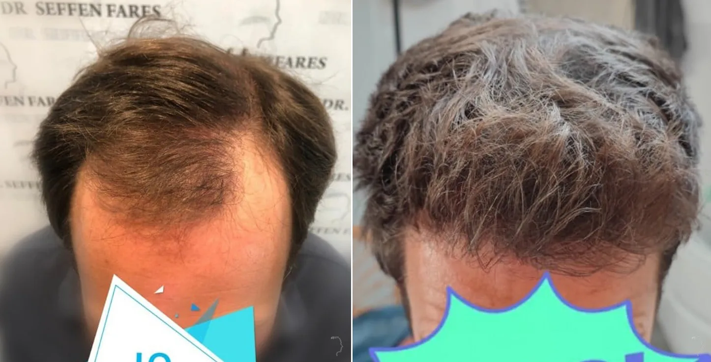 Patient 49, before and after hair transplant, view 3