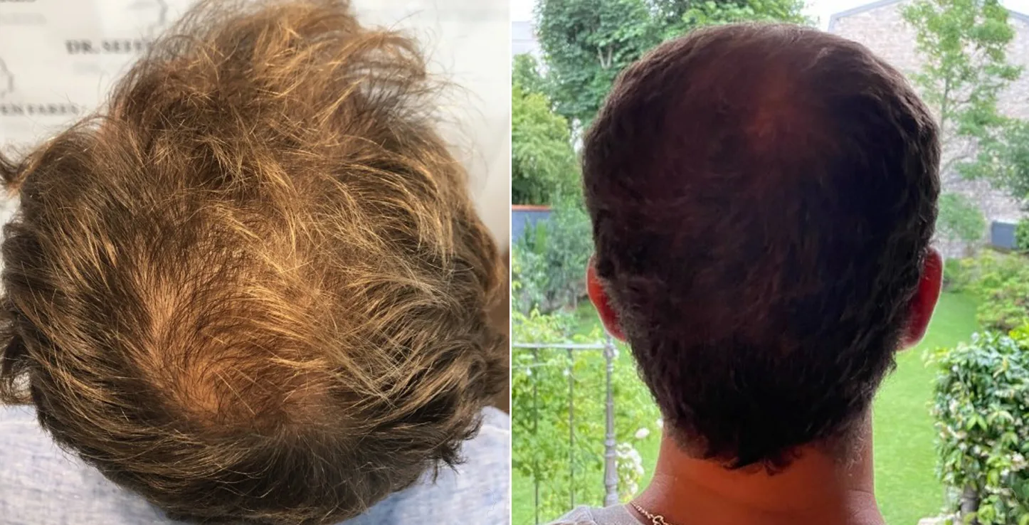 Patient 50, avant et après greffe de cheveux, vue 3