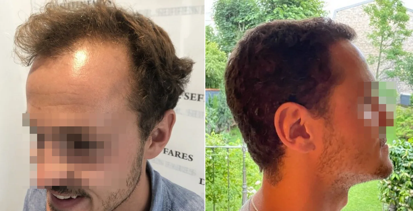 Patient 50, before and after hair transplant, view 2