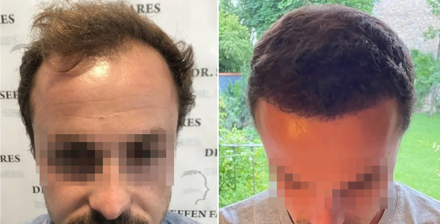 Patient 50, before and after hair transplant, view 1