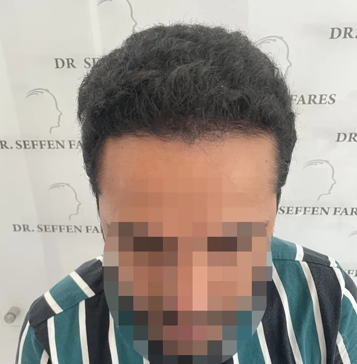 Patient 51, after hair transplant