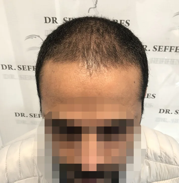 Patient 51, before hair transplant