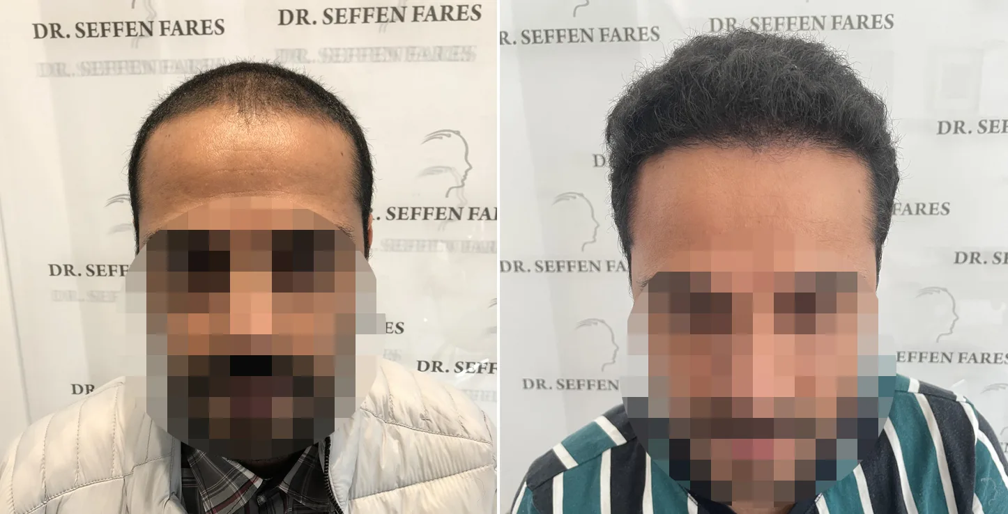 Patient 51, before and after hair transplant, view 2