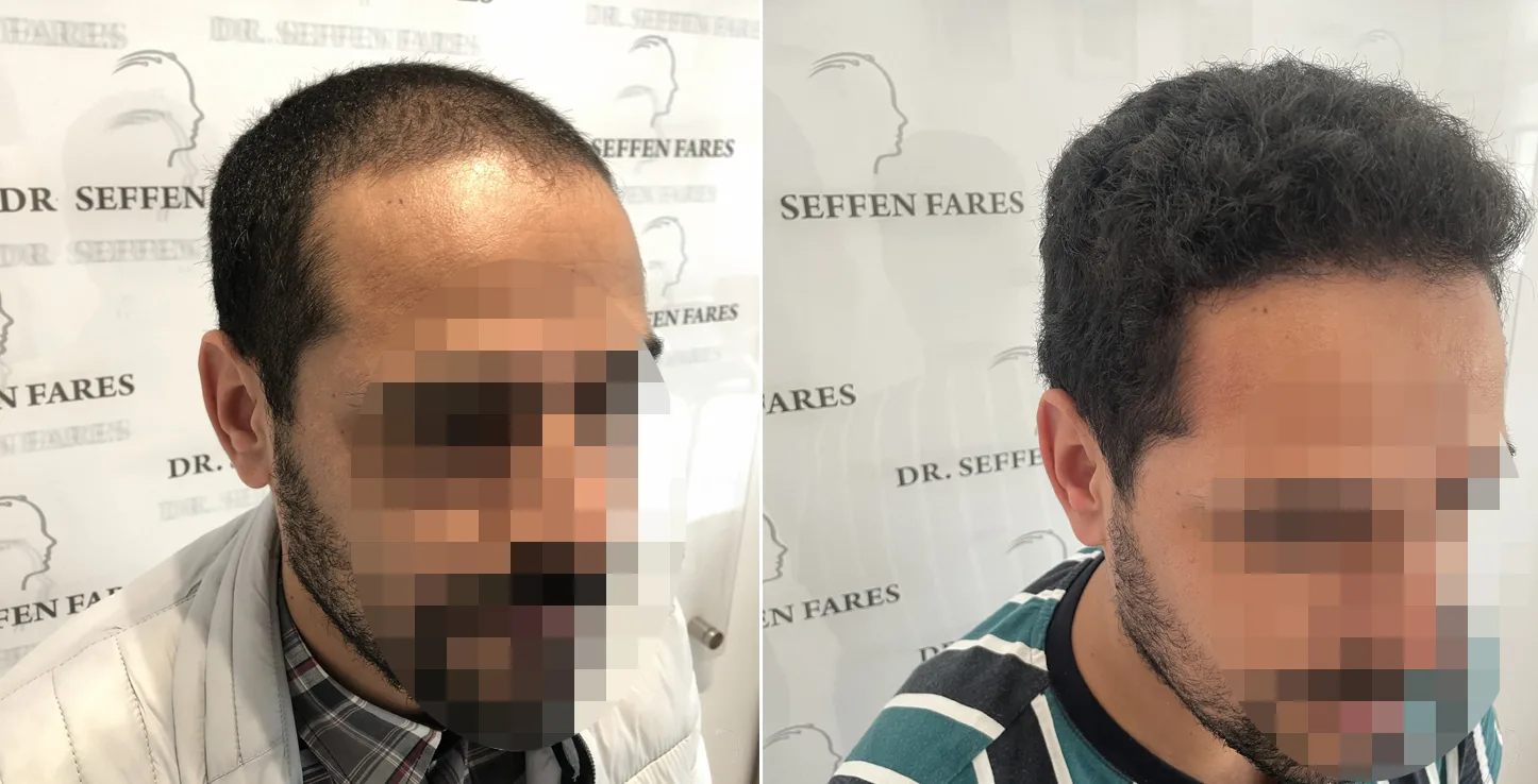 Patient 51, before and after hair transplant, view 3