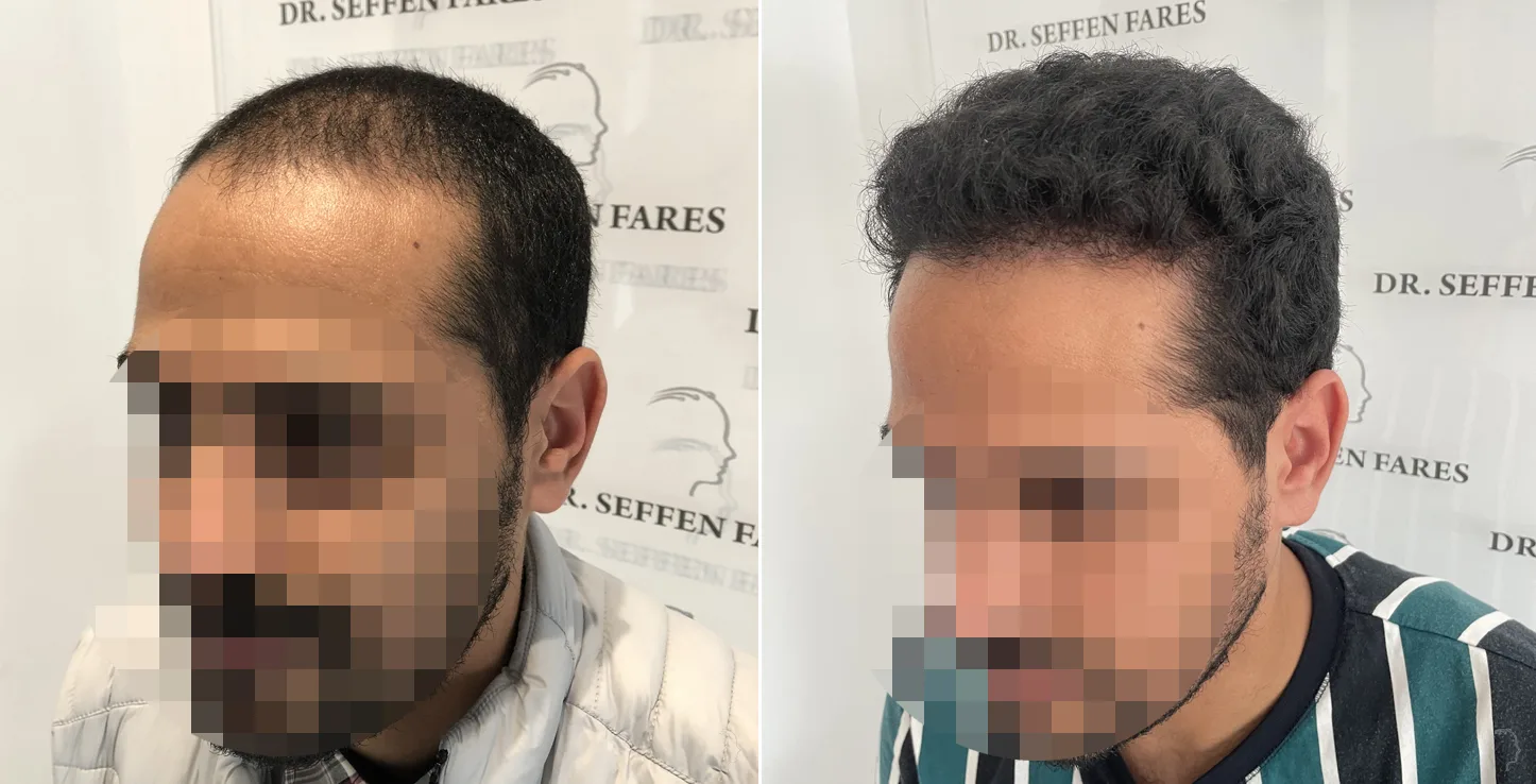 Patient 51, before and after hair transplant, view 4