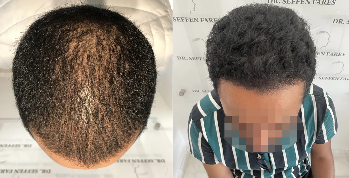 Patient 51, before and after hair transplant, view 5