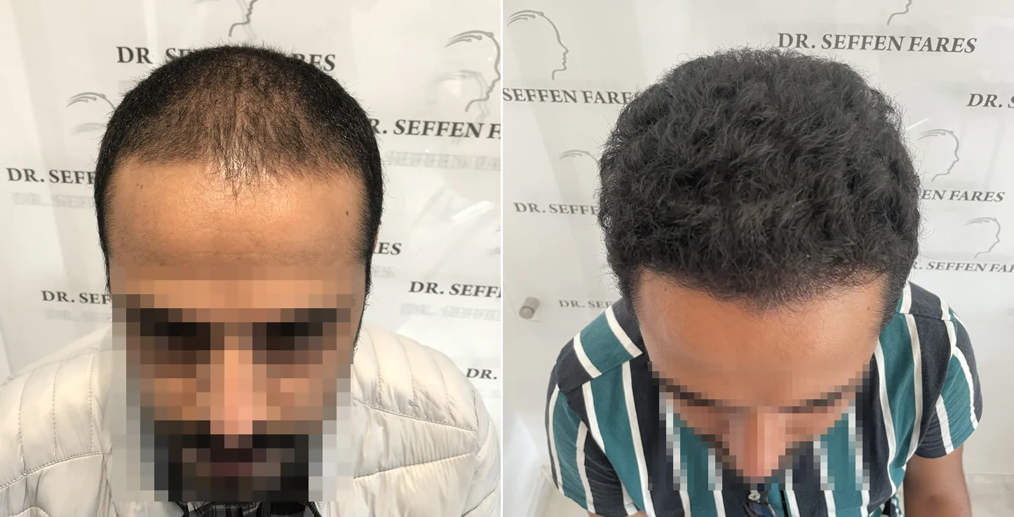 Patient 51, before and after hair transplant, view 1