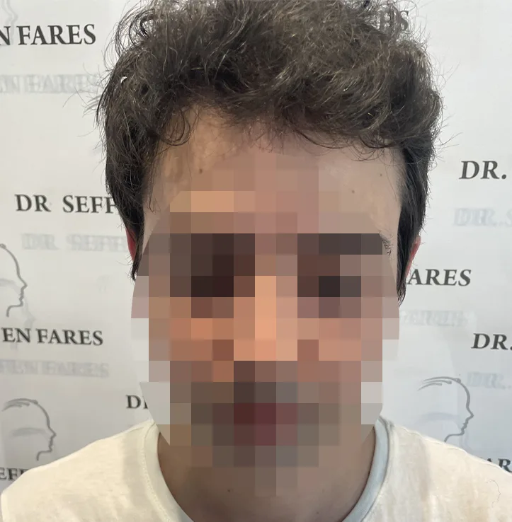 Patient 52 — 3,654 grafts · Norwood 4, after hair transplant
