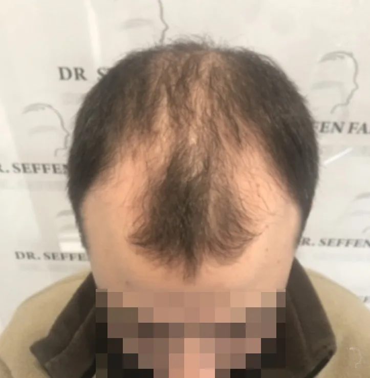 Patient 52 — 3,654 grafts · Norwood 4, before hair transplant