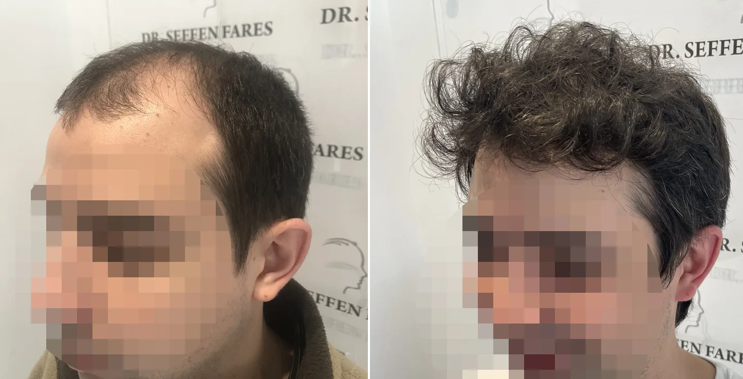 Patient 52, before and after hair transplant, view 2