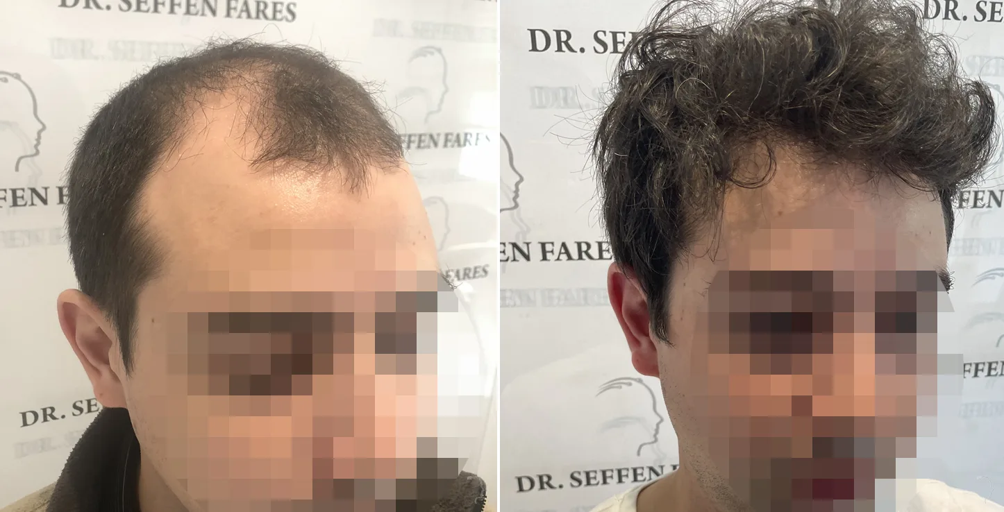 Patient 52, before and after hair transplant, view 3