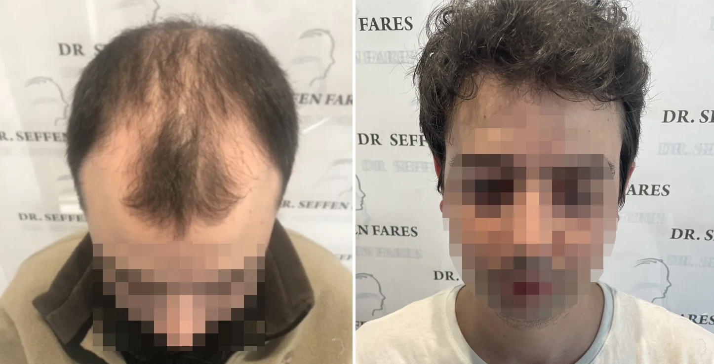 Patient 52, before and after hair transplant, view 1