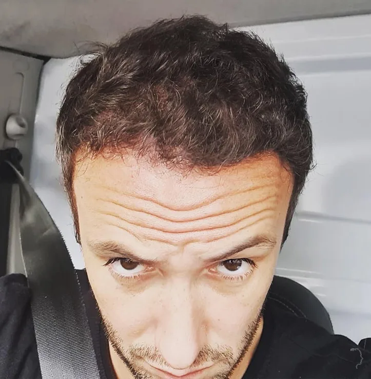 Patient 53, after hair transplant
