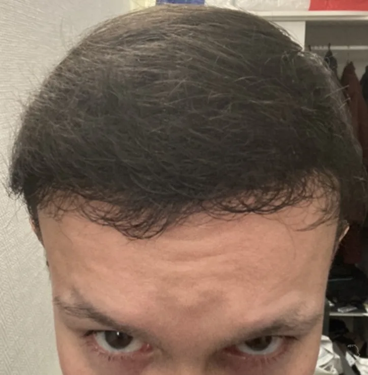 Patient 54 — 3,954 grafts · Norwood 7, after hair transplant