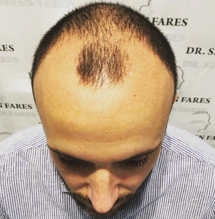 Patient 53, before hair transplant