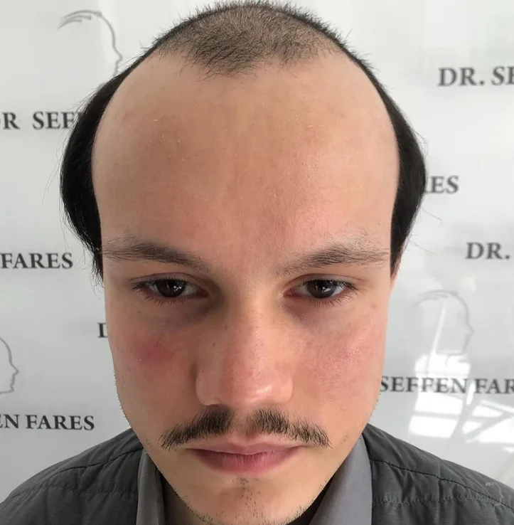 Patient 54 — 3,954 grafts · Norwood 7, before hair transplant