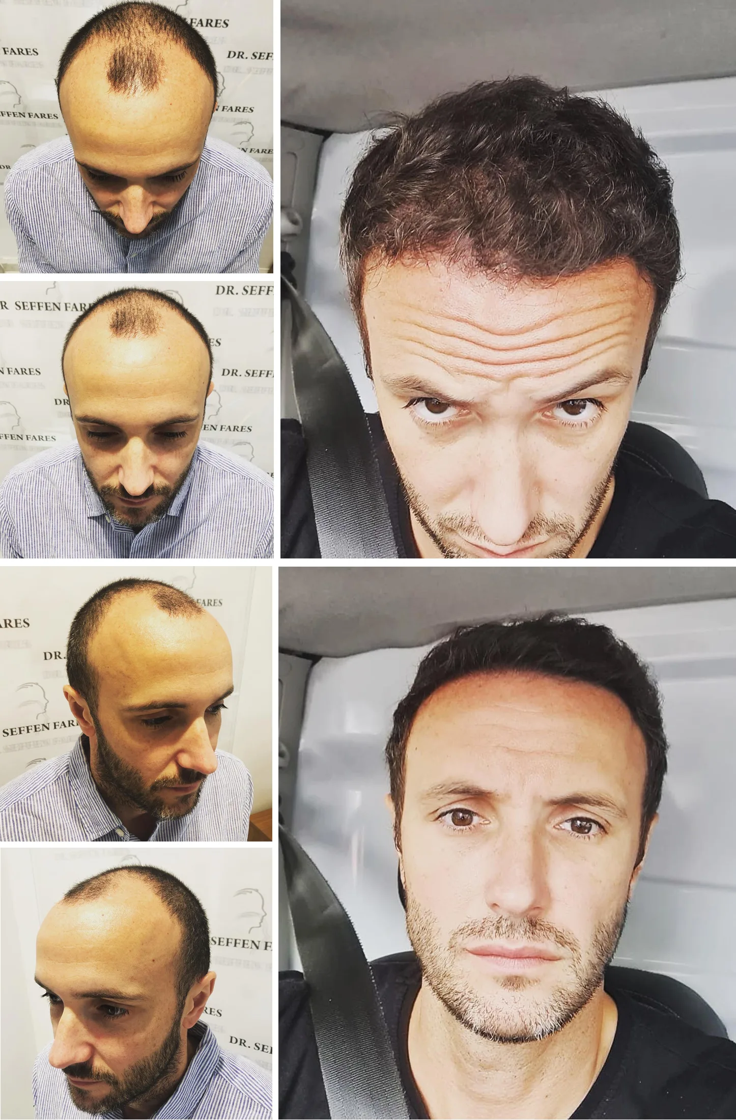 Patient 53, before and after hair transplant, view 1
