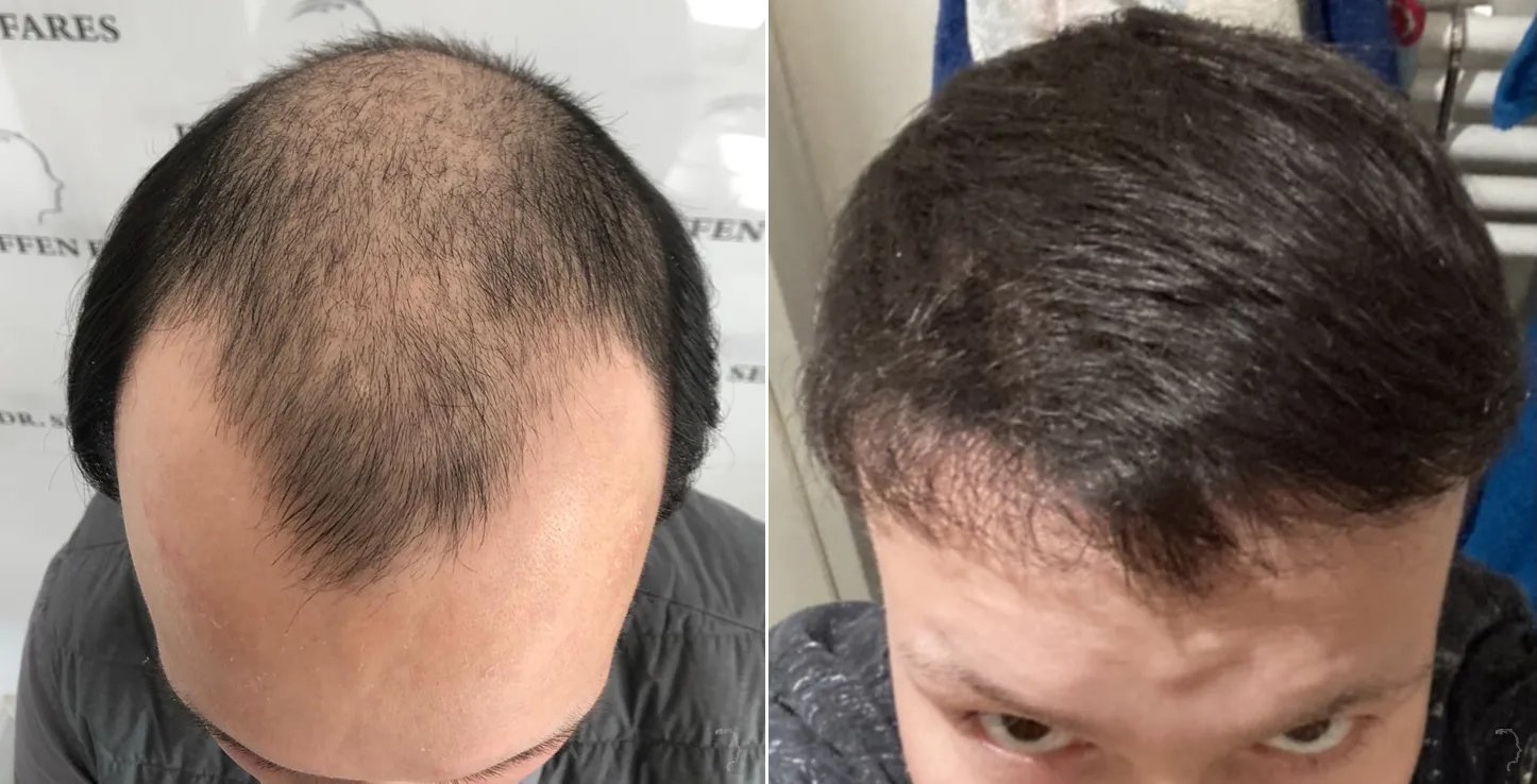 Patient 54, before and after hair transplant, view 2