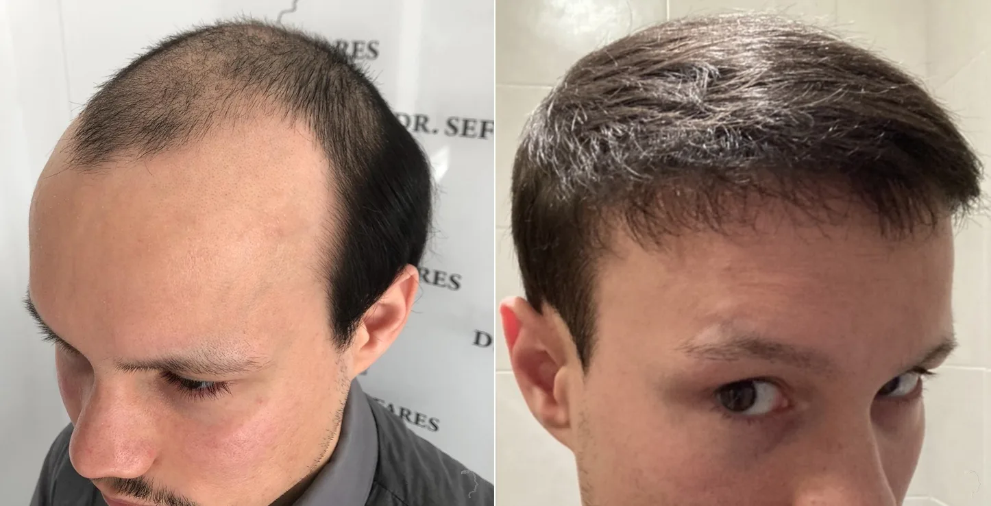 Patient 54, before and after hair transplant, view 3