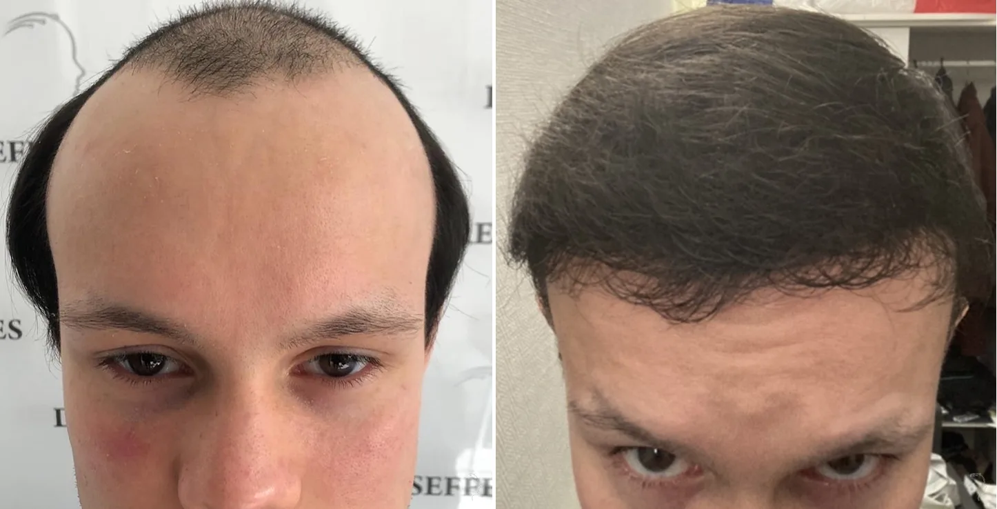 Patient 54, before and after hair transplant, view 1