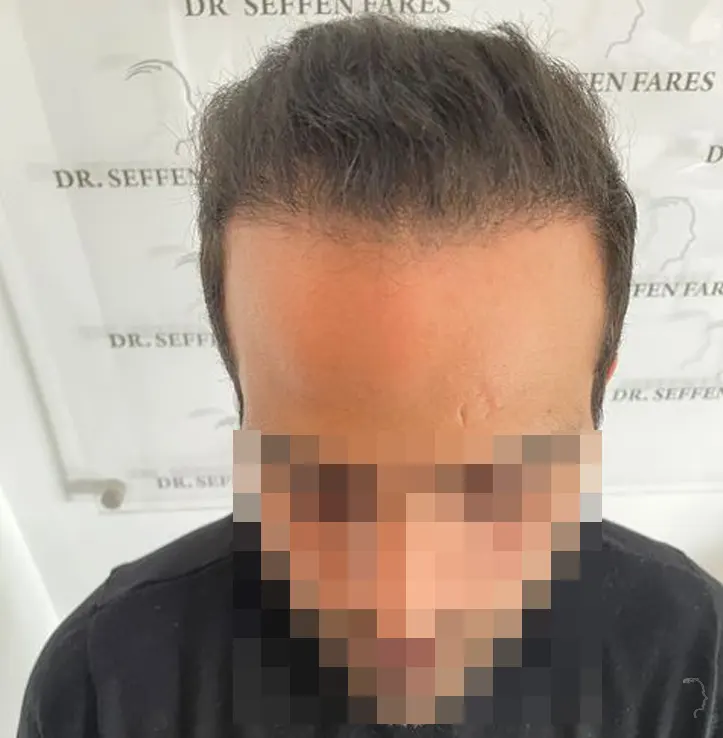Patient 55 — 3,454 grafts · Norwood 6, after hair transplant