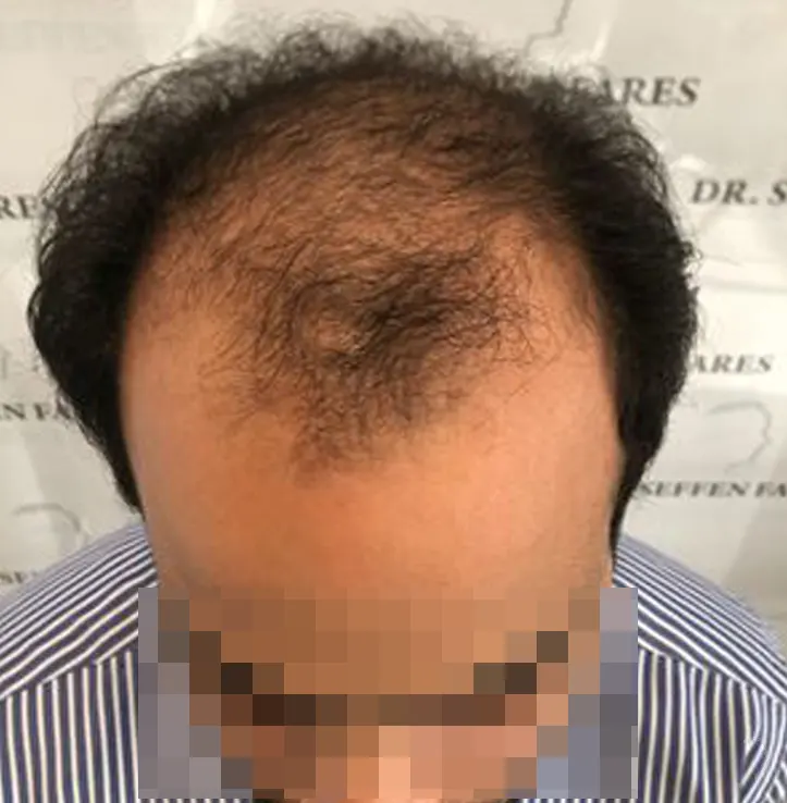 Patient 55 — 3,454 grafts · Norwood 6, before hair transplant