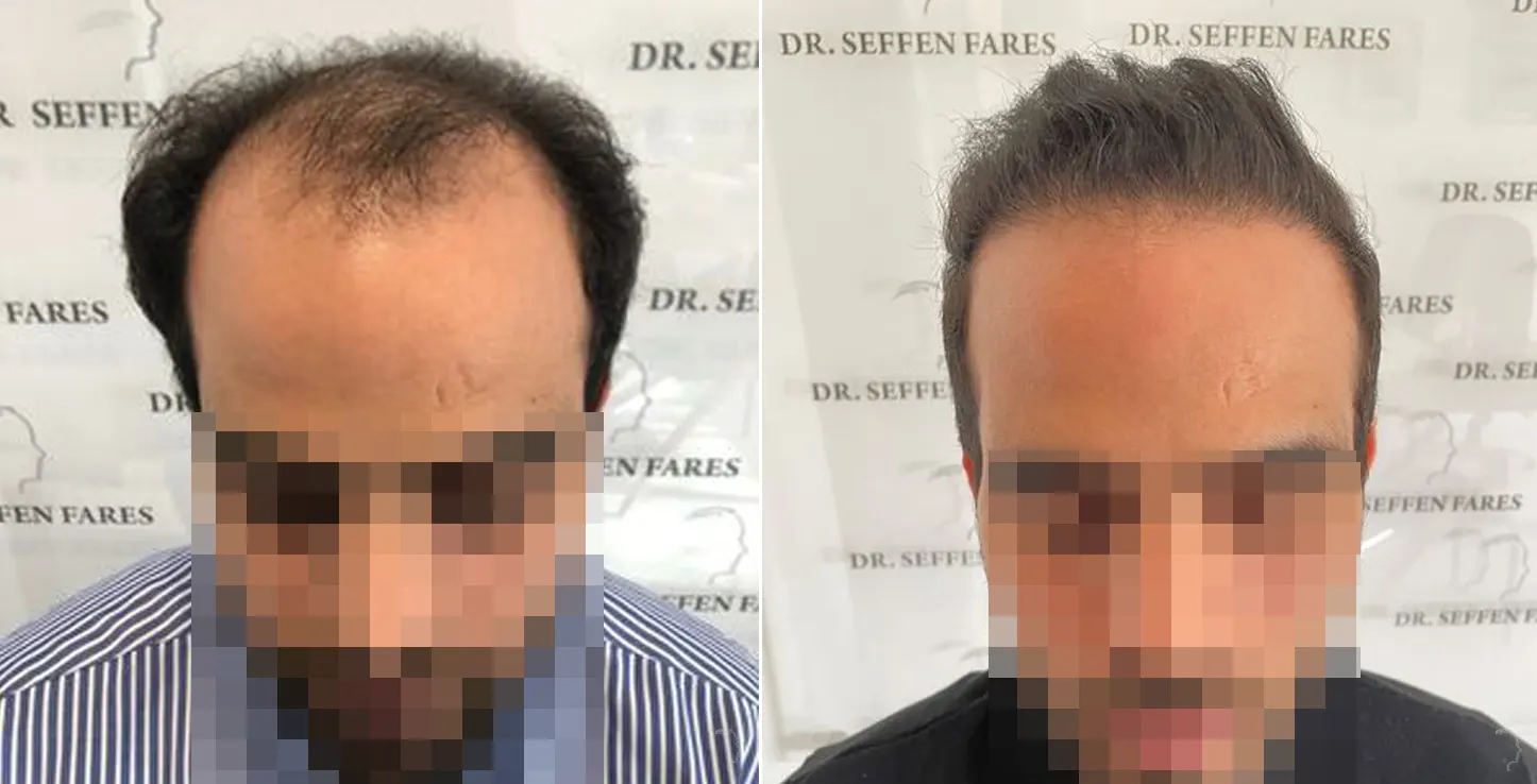 Patient 55, before and after hair transplant, view 2