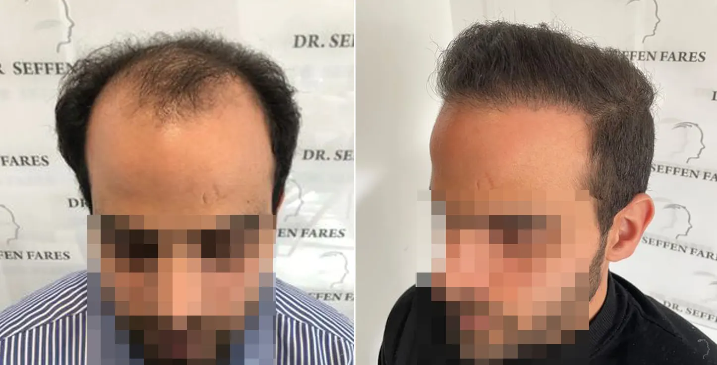 Patient 55, before and after hair transplant, view 3