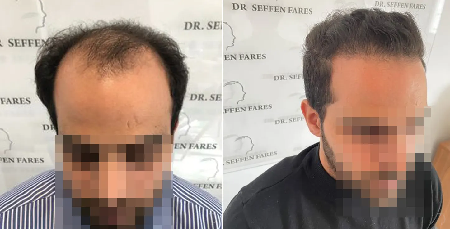 Patient 55, before and after hair transplant, view 4