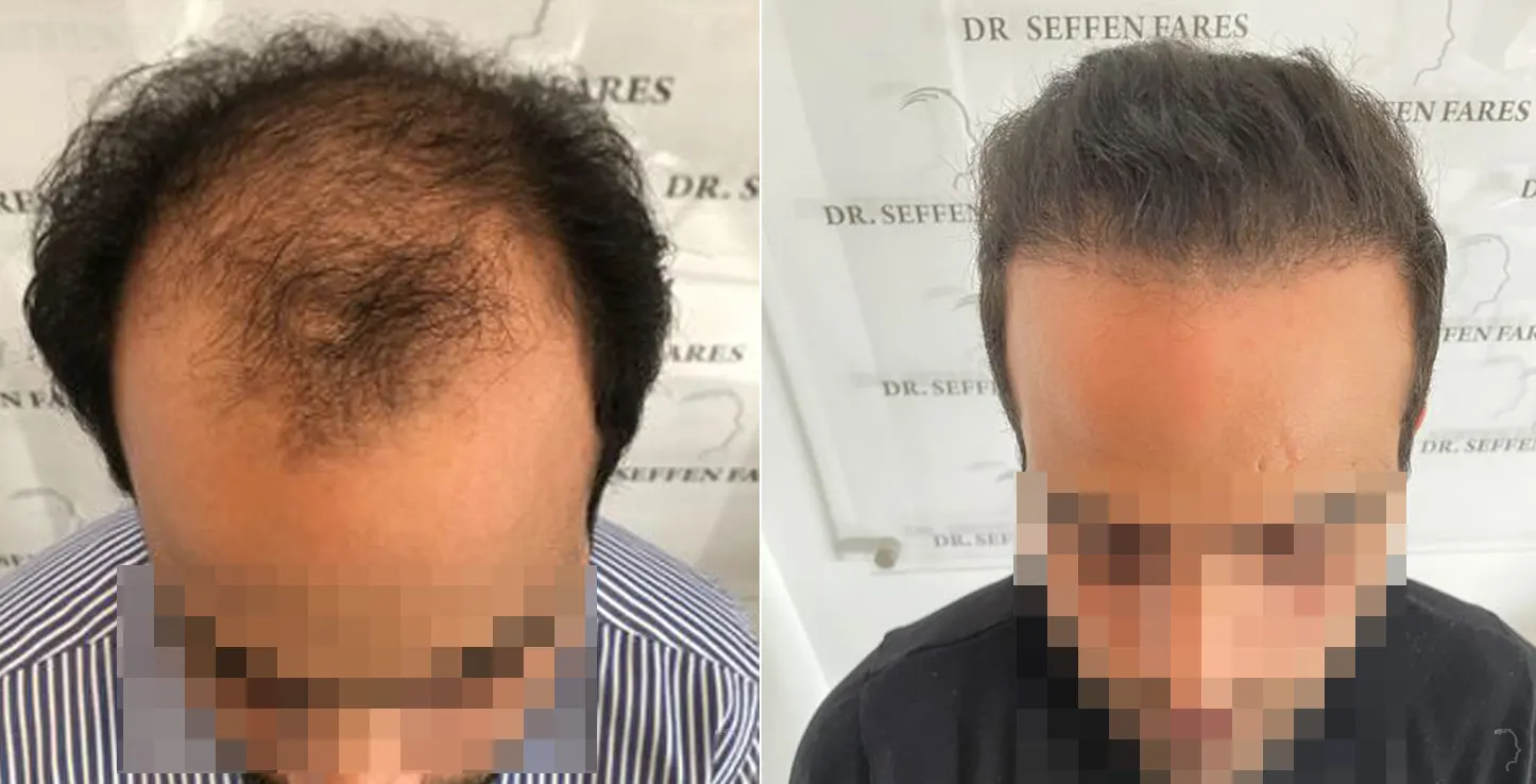 Patient 55, before and after hair transplant, view 1