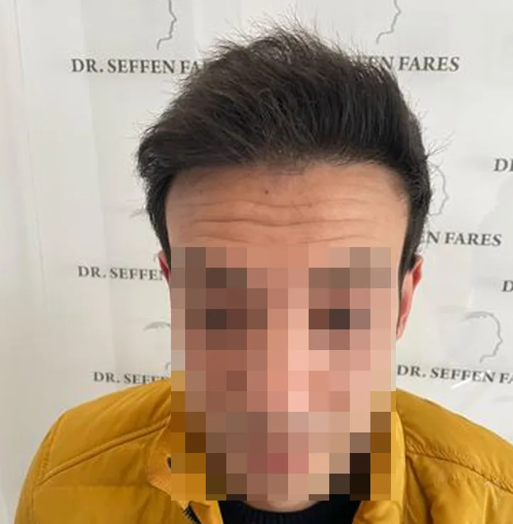 Patient 56 — 2,234 grafts · Norwood 2, after hair transplant