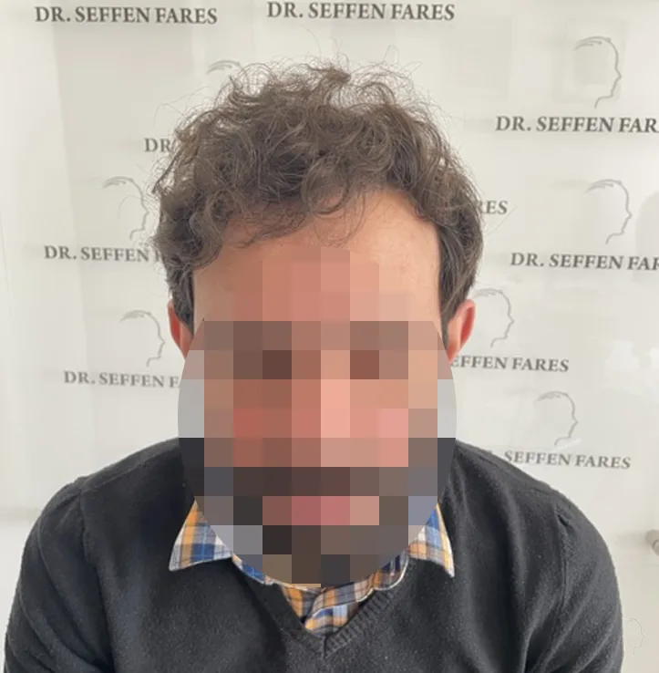 Patient 57 — 4,089 grafts · Norwood 5, after hair transplant