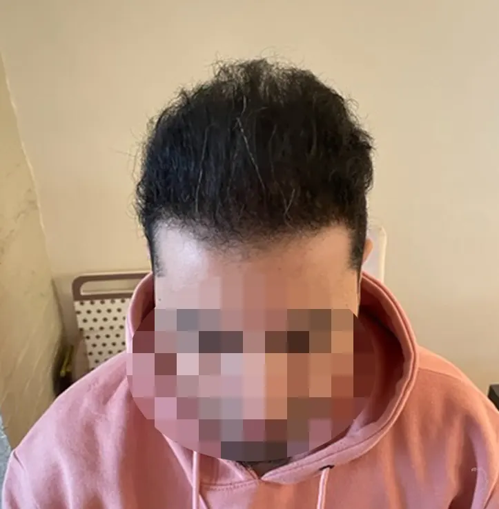 Patient 58 — 3,342 grafts · Norwood 5, after hair transplant