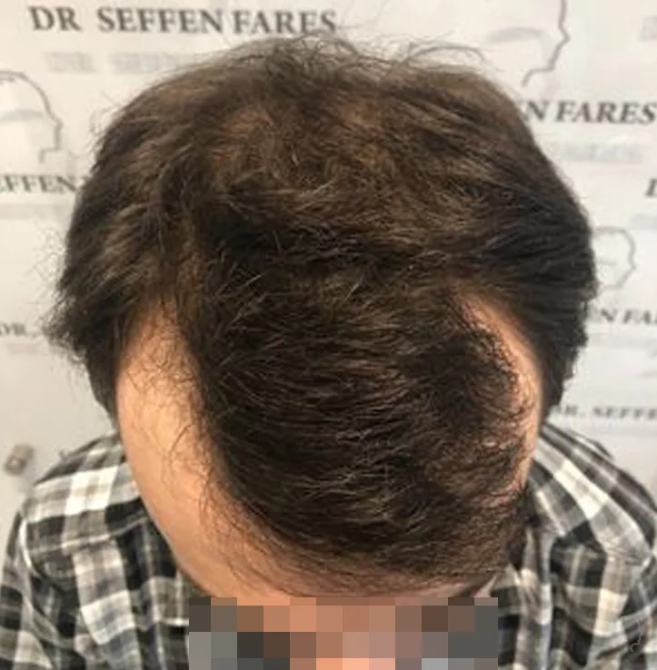 Patient 56 — 2,234 grafts · Norwood 2, before hair transplant