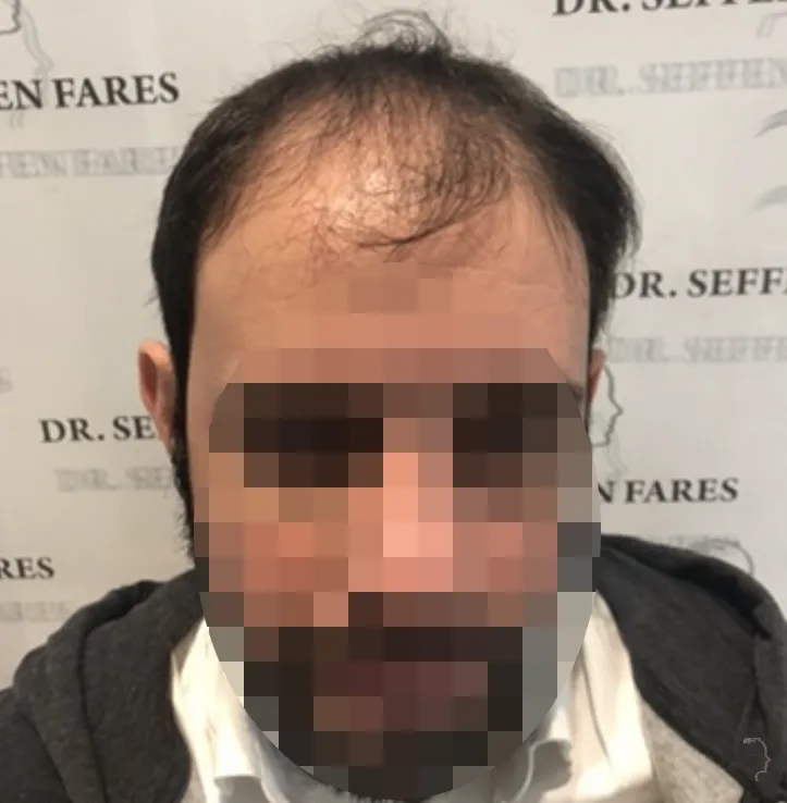 Patient 57 — 4,089 grafts · Norwood 5, before hair transplant