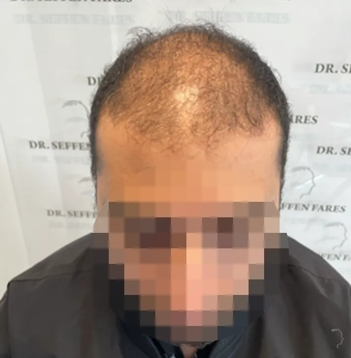 Patient 58 — 3,342 grafts · Norwood 5, before hair transplant