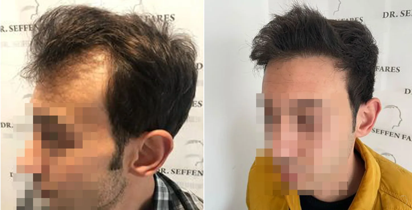 Patient 56, avant et après greffe de cheveux, vue 3