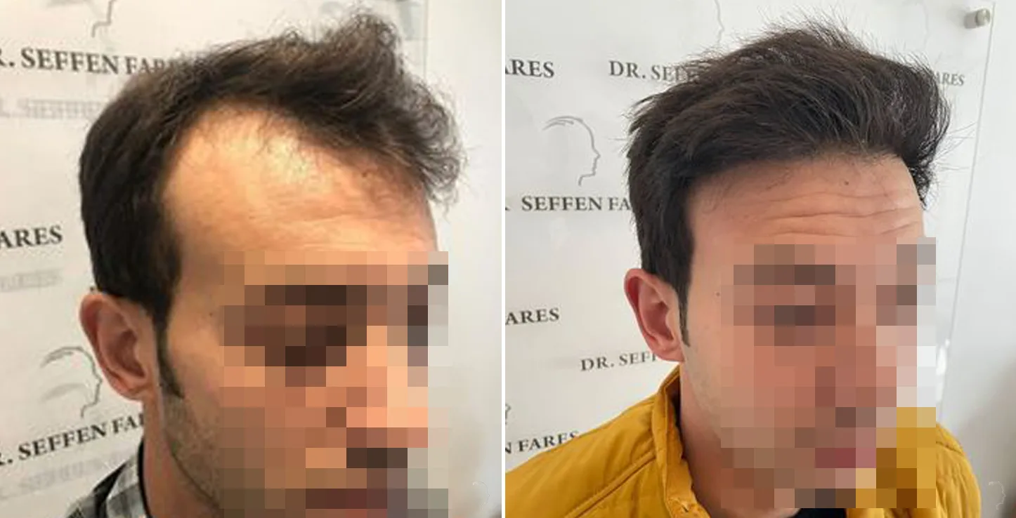 Patient 56, before and after hair transplant, view 1