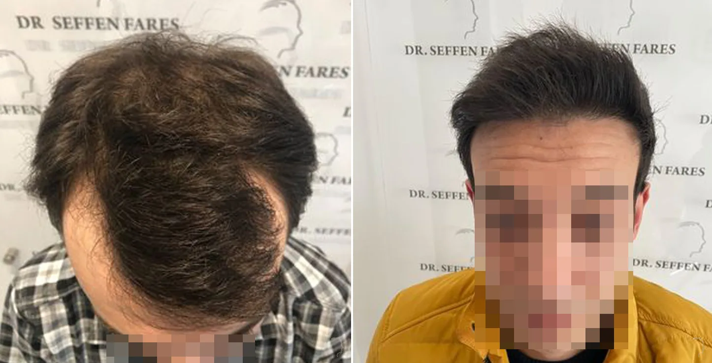Patient 56, before and after hair transplant, view 2