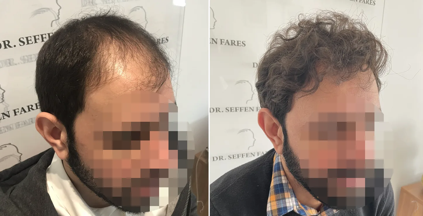 Patient 57, before and after hair transplant, view 2
