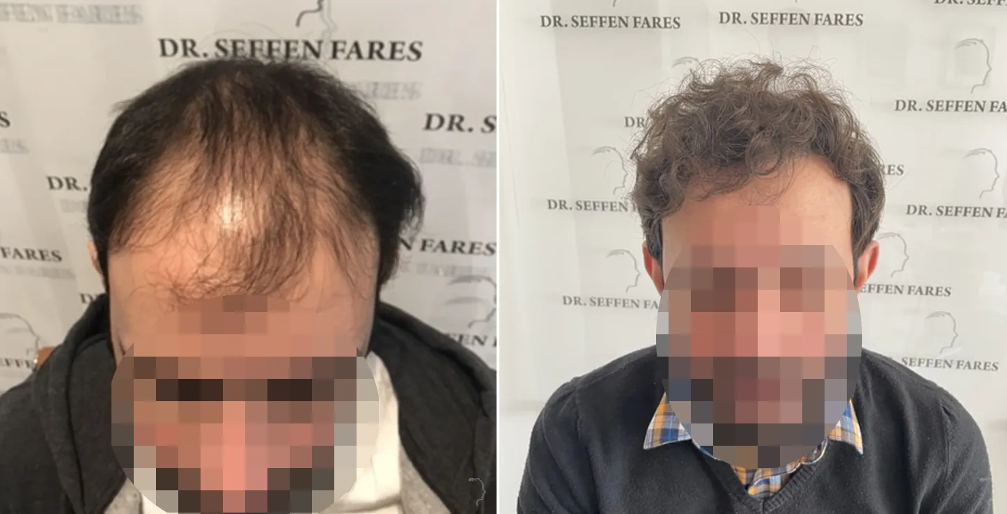Patient 57, avant et après greffe de cheveux, vue 3