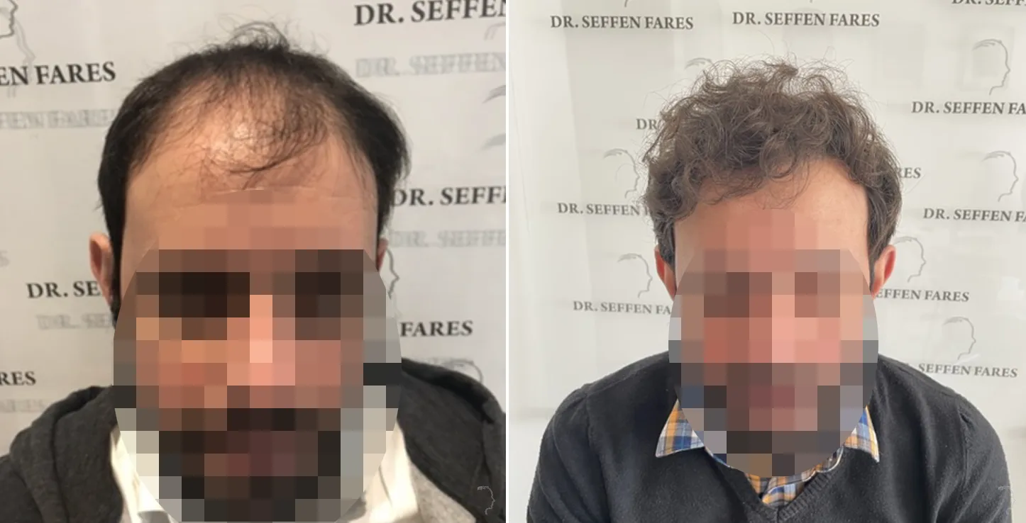 Patient 57, before and after hair transplant, view 1