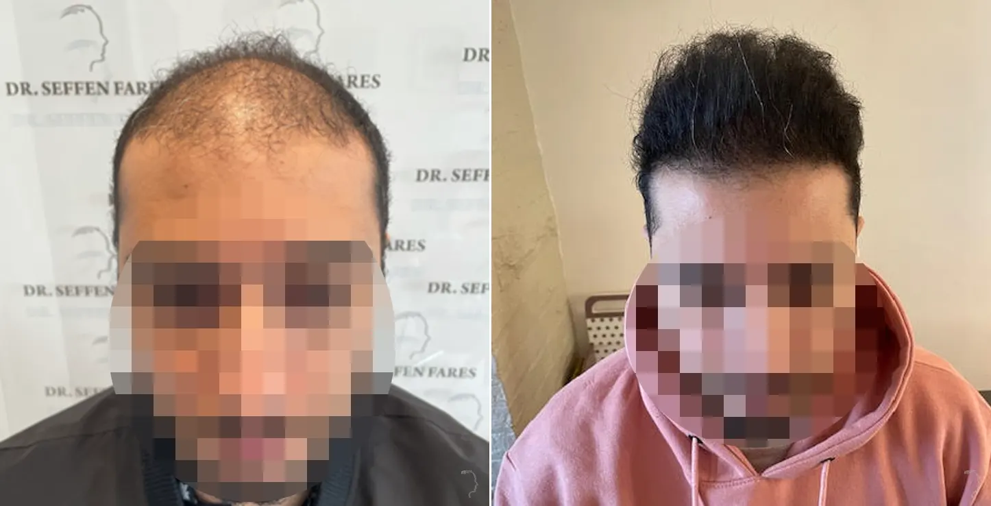 Patient 58, avant et après greffe de cheveux, vue 2