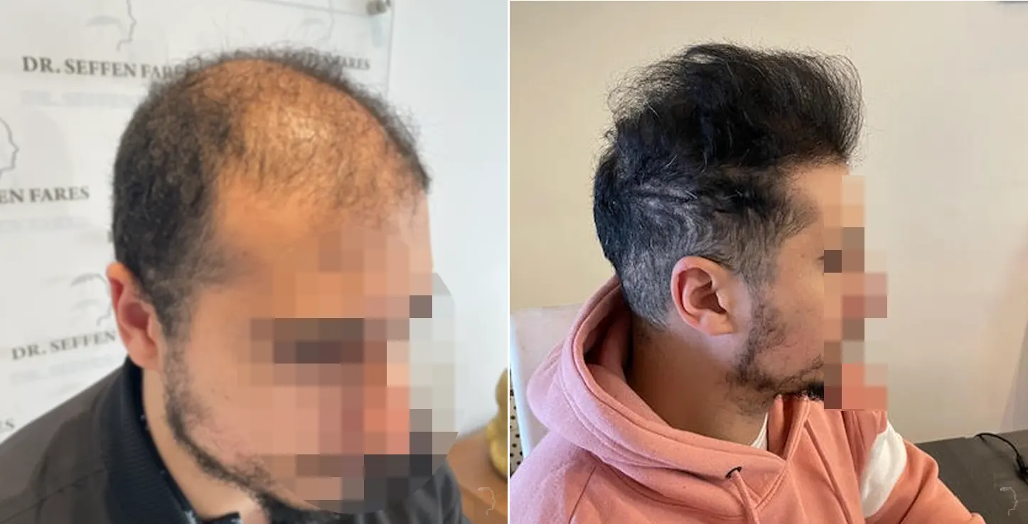 Patient 58, before and after hair transplant, view 3
