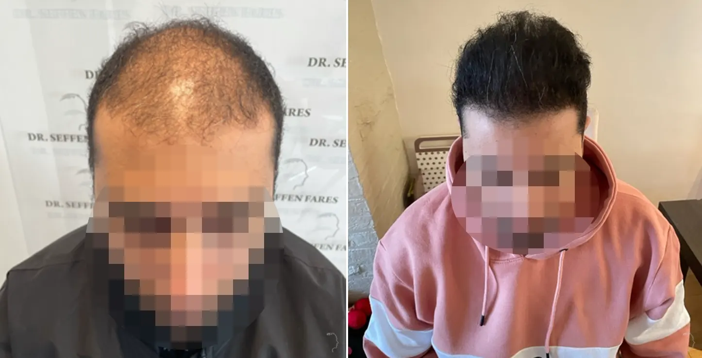 Patient 58, before and after hair transplant, view 1
