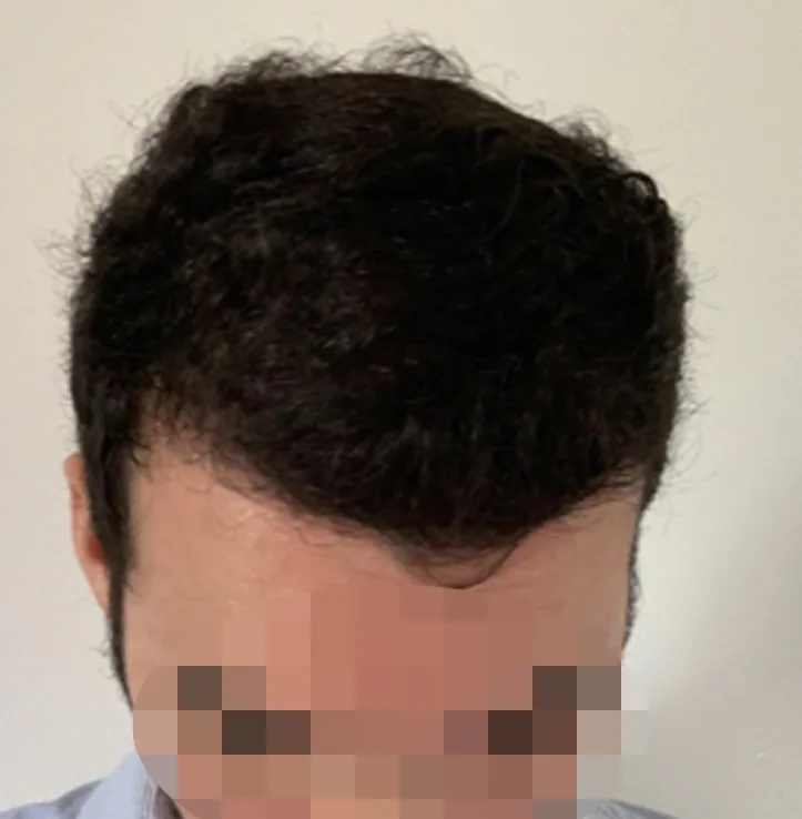 Patient 59 — 3,542 grafts · Norwood 5, after hair transplant