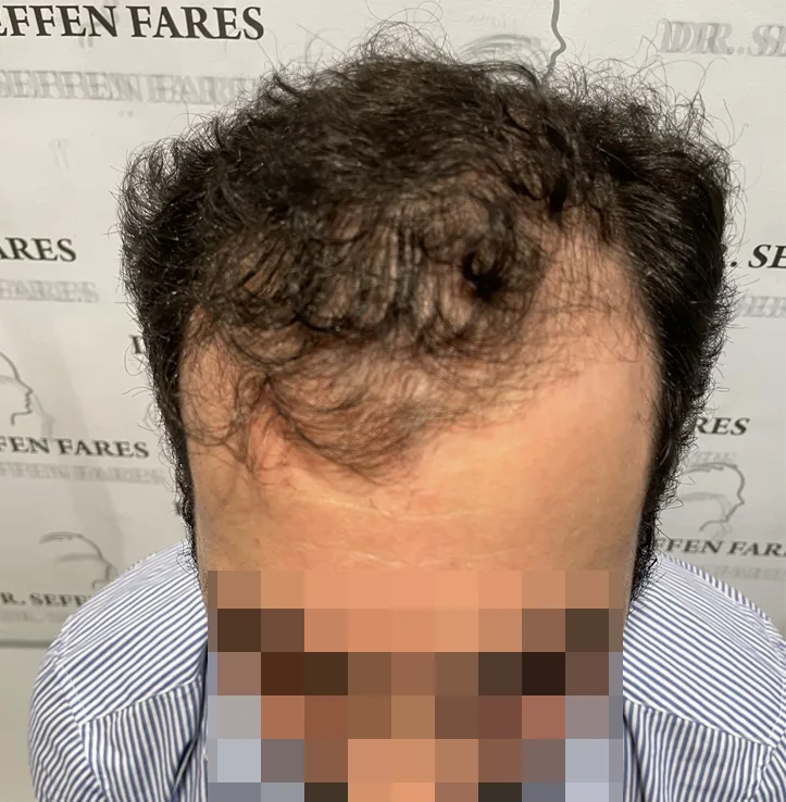 Patient 59 — 3,542 grafts · Norwood 5, before hair transplant