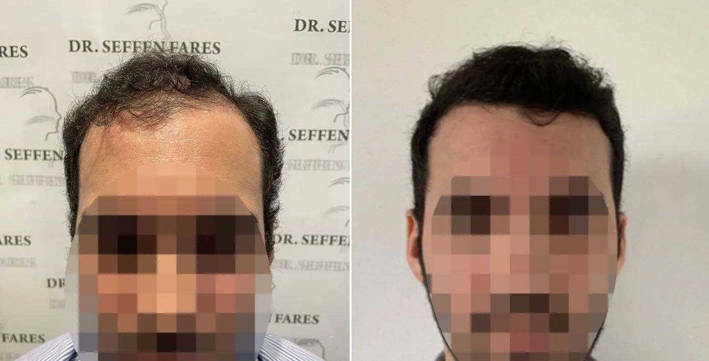 Patient 59, before and after hair transplant, view 2