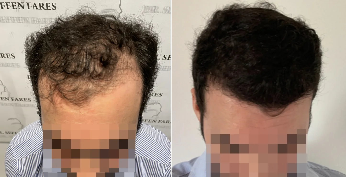 Patient 59, before and after hair transplant, view 1